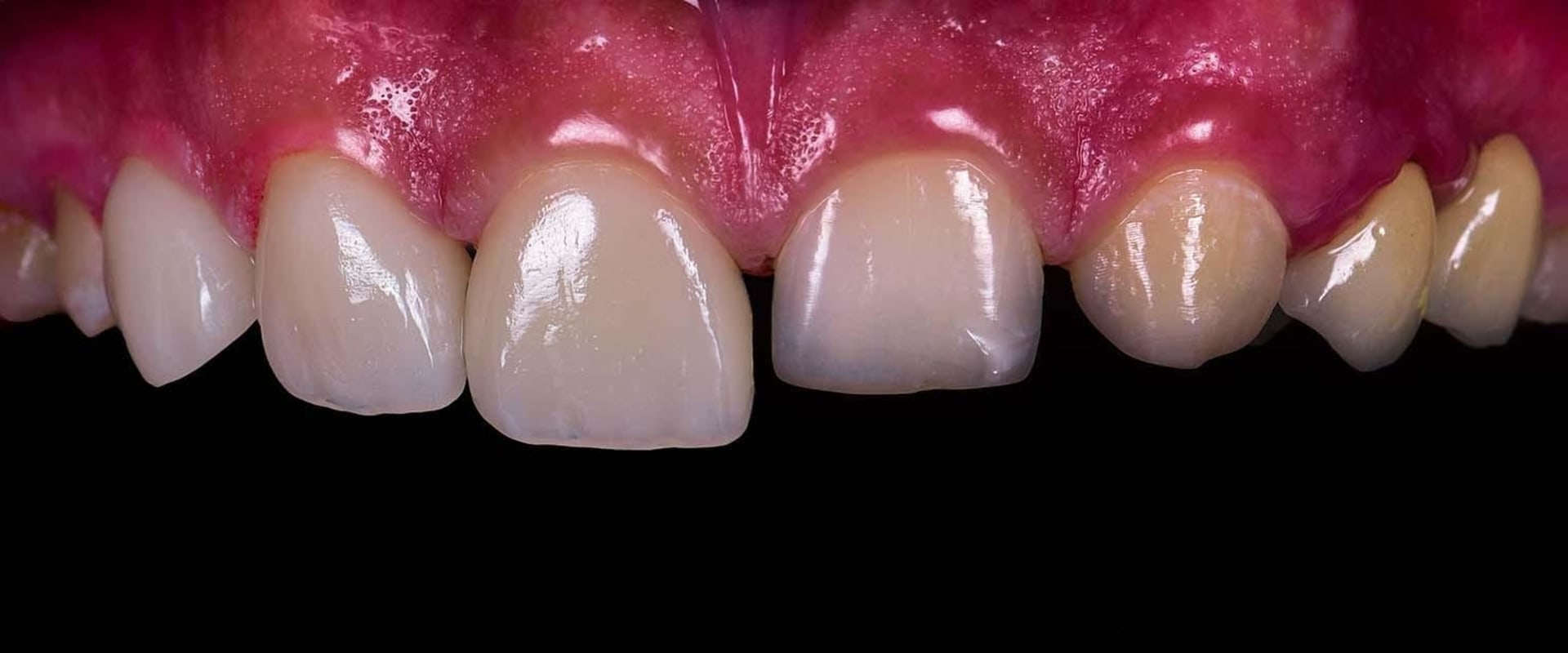 The Procedure for Getting Veneers: A Comprehensive Guide