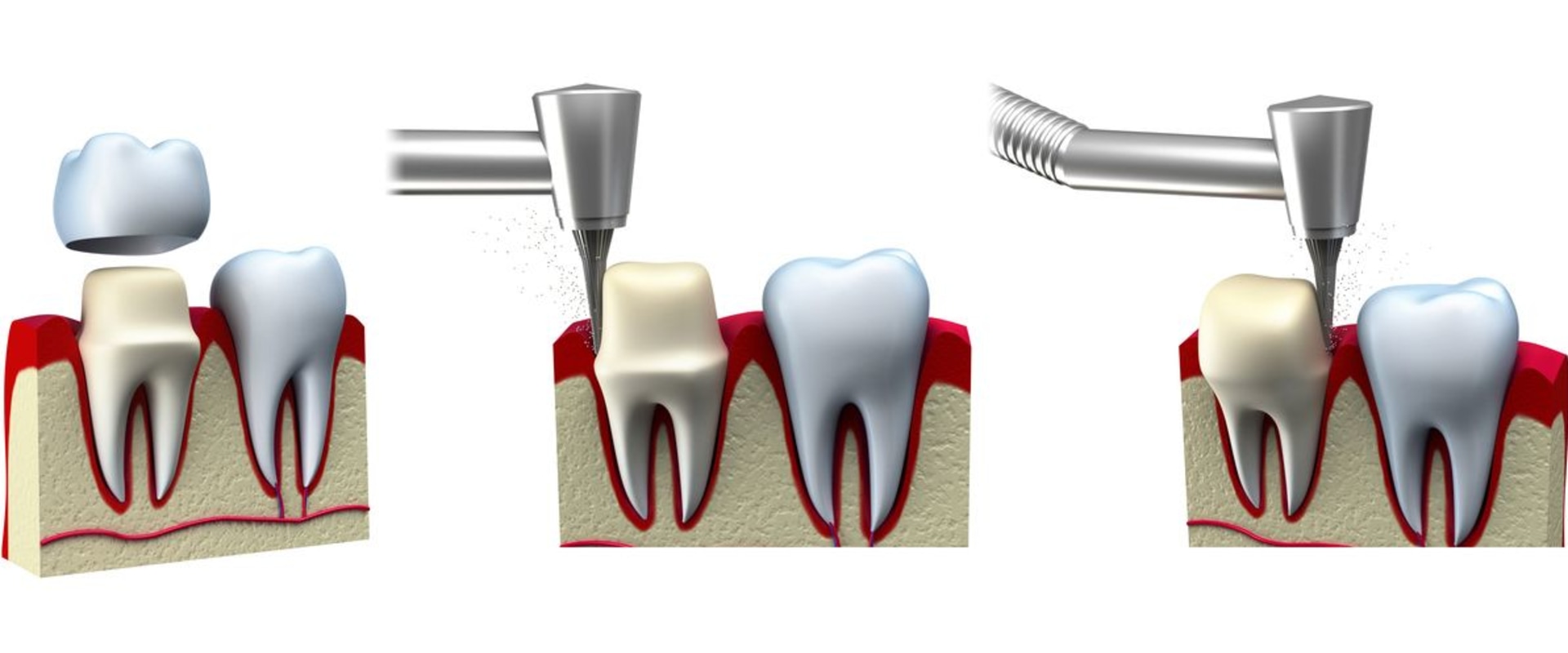 Steps to Getting a Dental Crown: What You Need to Know