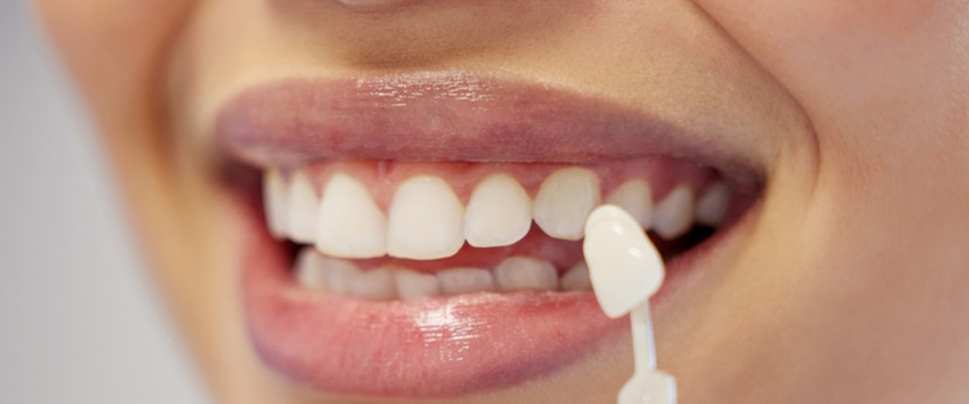 Understanding Maintenance for Veneers: A Complete Guide