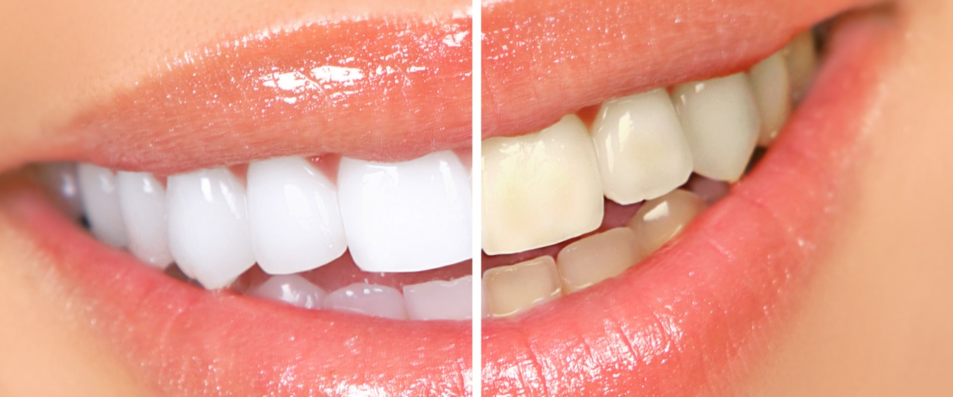 Caring for Teeth After Whitening: Tips and Tricks to Keep Your Smile Bright