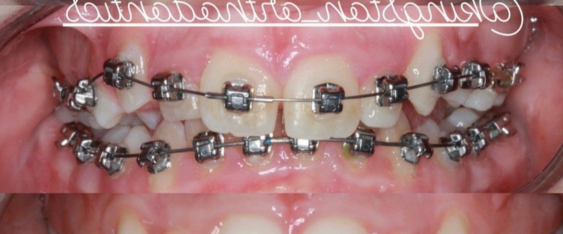 A Comprehensive Overview of Different Types of Orthodontic Treatments