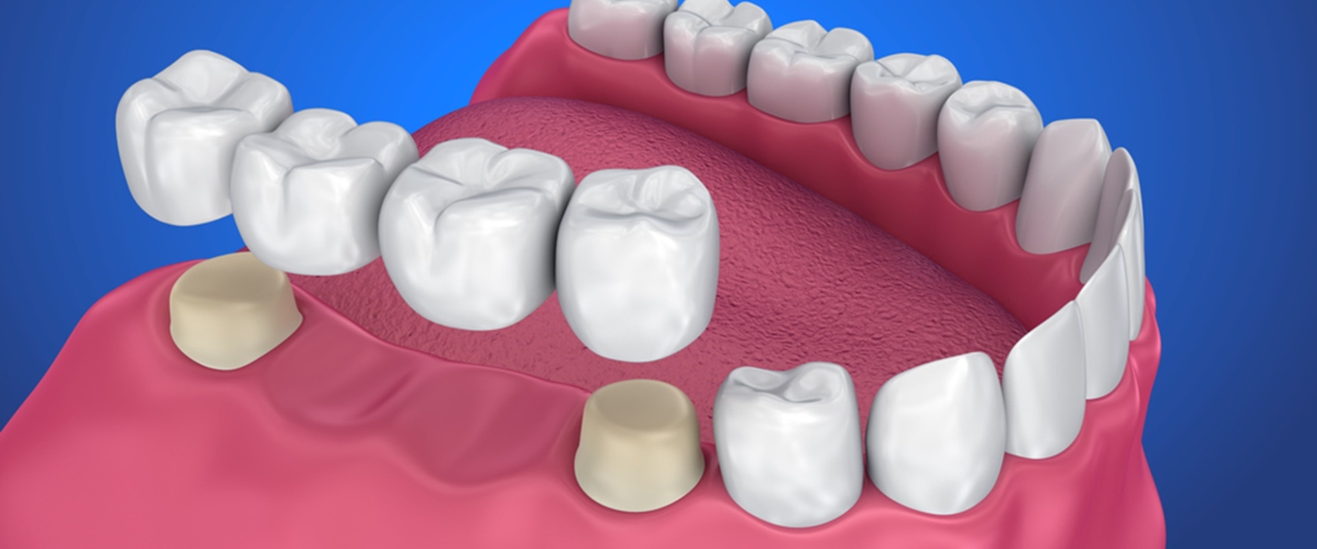 Maintenance for Dental Bridges: Keeping Your Smile and Wallet Healthy