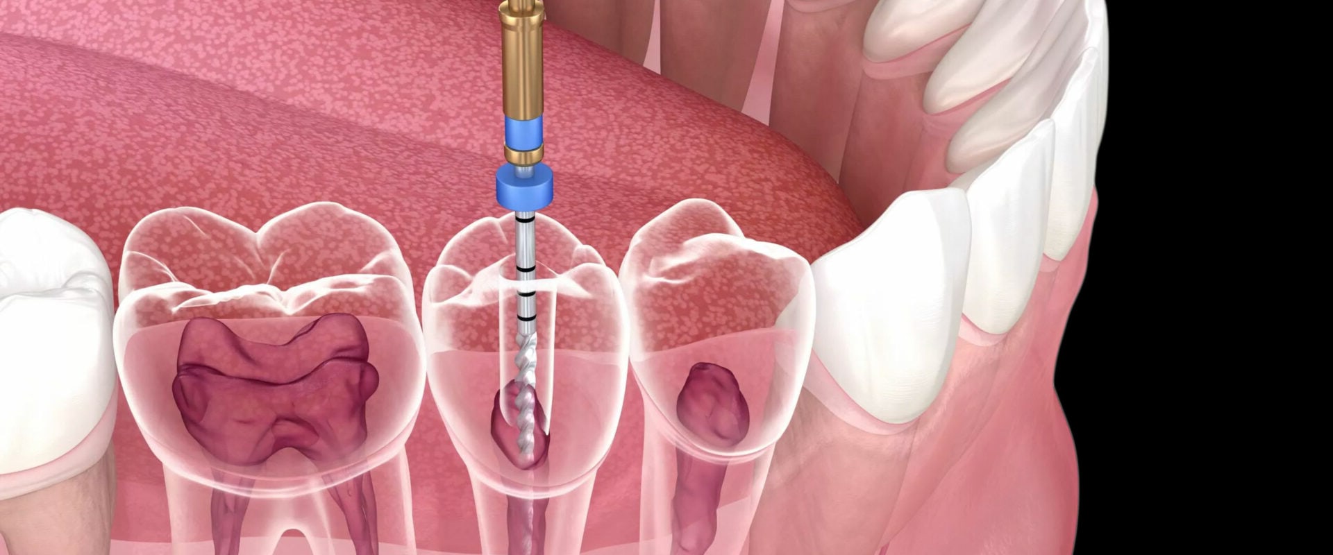 Understanding the Procedure for a Root Canal