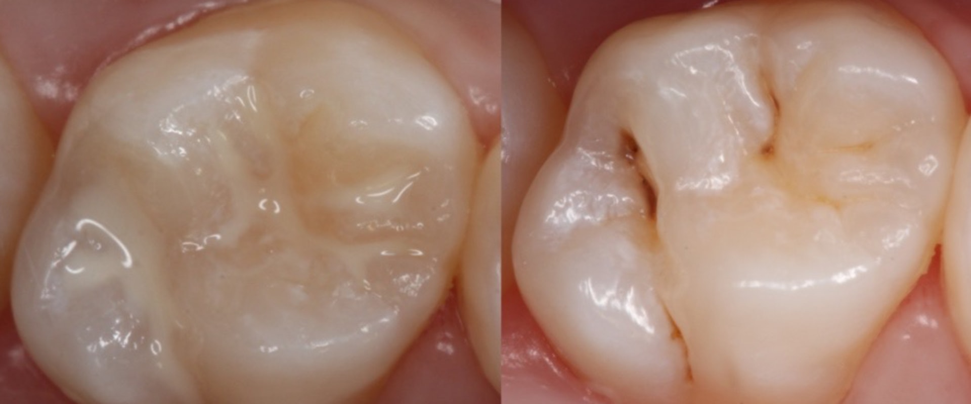 Exploring the Different Types of Dental Sealants