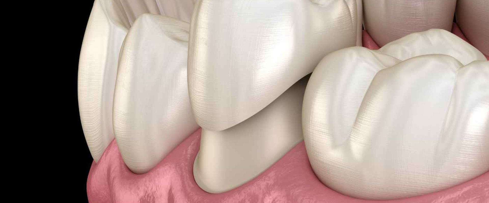 Different Types of Dental Crowns: A Comprehensive Guide