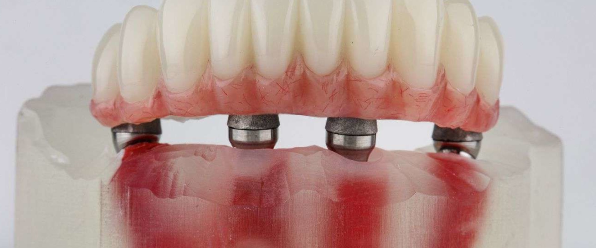 The Benefits of Dental Bridges: Affordable Coverage for Your Oral Health