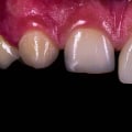 The Procedure for Getting Veneers: A Comprehensive Guide