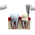 Steps to Getting a Dental Crown: What You Need to Know