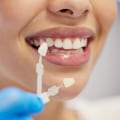 Understanding Maintenance for Veneers: A Complete Guide