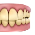 Understanding the Causes of Tooth Discoloration