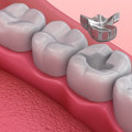 Understanding the Different Types of Dental Fillings