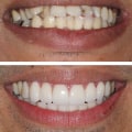 A Comprehensive Look at the Different Types of Dental Veneers