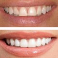 Understanding the Pros and Cons of PPOs for Affordable Dental Coverage