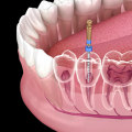 Understanding the Procedure for a Root Canal