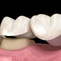 The Process for Getting a Dental Bridge: Everything You Need to Know