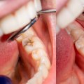 Care for Fillings: Everything You Need to Know