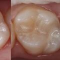 Exploring the Different Types of Dental Sealants