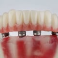 The Benefits of Dental Bridges: Affordable Coverage for Your Oral Health