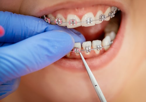 Steps for Getting Orthodontic Treatment