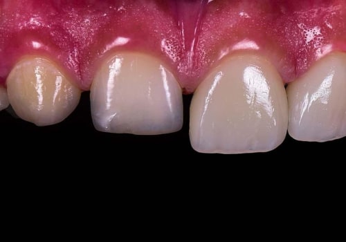 The Procedure for Getting Veneers: A Comprehensive Guide