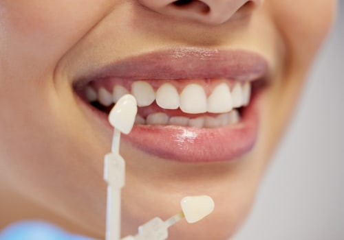Understanding Maintenance for Veneers: A Complete Guide