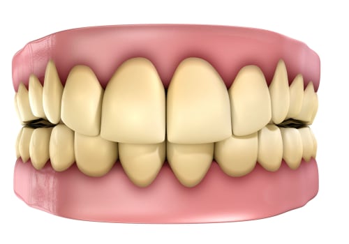 Understanding the Causes of Tooth Discoloration