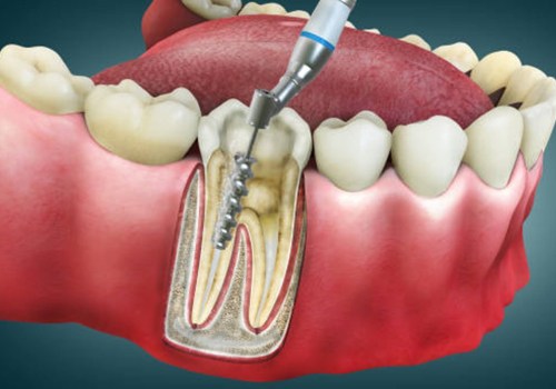 Aftercare for a Root Canal: Tips and Information for Affordable Dental Insurance Coverage