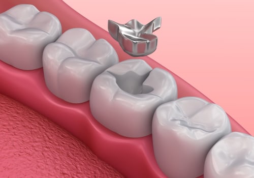 Understanding the Different Types of Dental Fillings