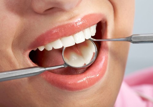 Understanding the Process of Getting a Dental Filling