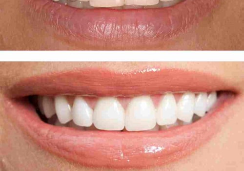 Understanding the Pros and Cons of PPOs for Affordable Dental Coverage