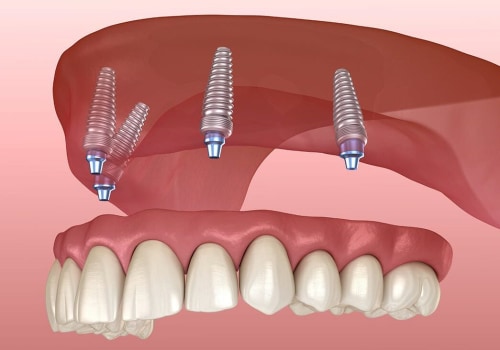A Comprehensive Guide to Getting Affordable Dental Implants