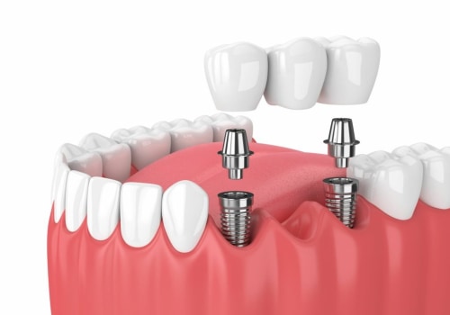 The Benefits of Dental Implants: Improving Your Oral Health and Saving Money