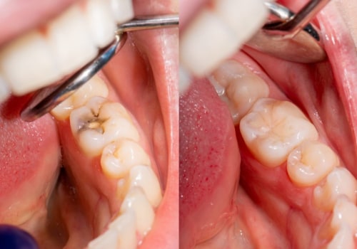 Care for Fillings: Everything You Need to Know
