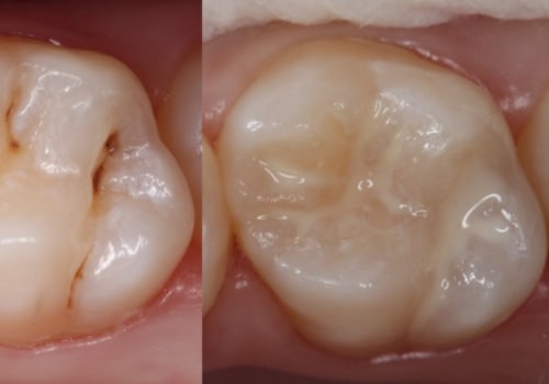 Exploring the Different Types of Dental Sealants