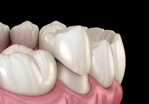 Different Types of Dental Crowns: A Comprehensive Guide