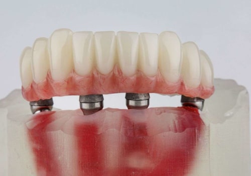 The Benefits of Dental Bridges: Affordable Coverage for Your Oral Health